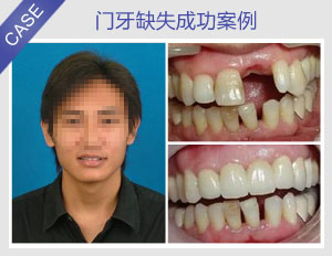 西安圣贝口腔医院 真人案例 牙齿种植案例  项目名称:单颗种植牙修复