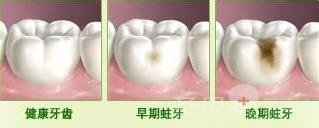 怎样有效的预防蛀牙