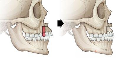 所謂假齙牙,指的是上牙有效或接近正常位置,真正原因是下顎骨太短